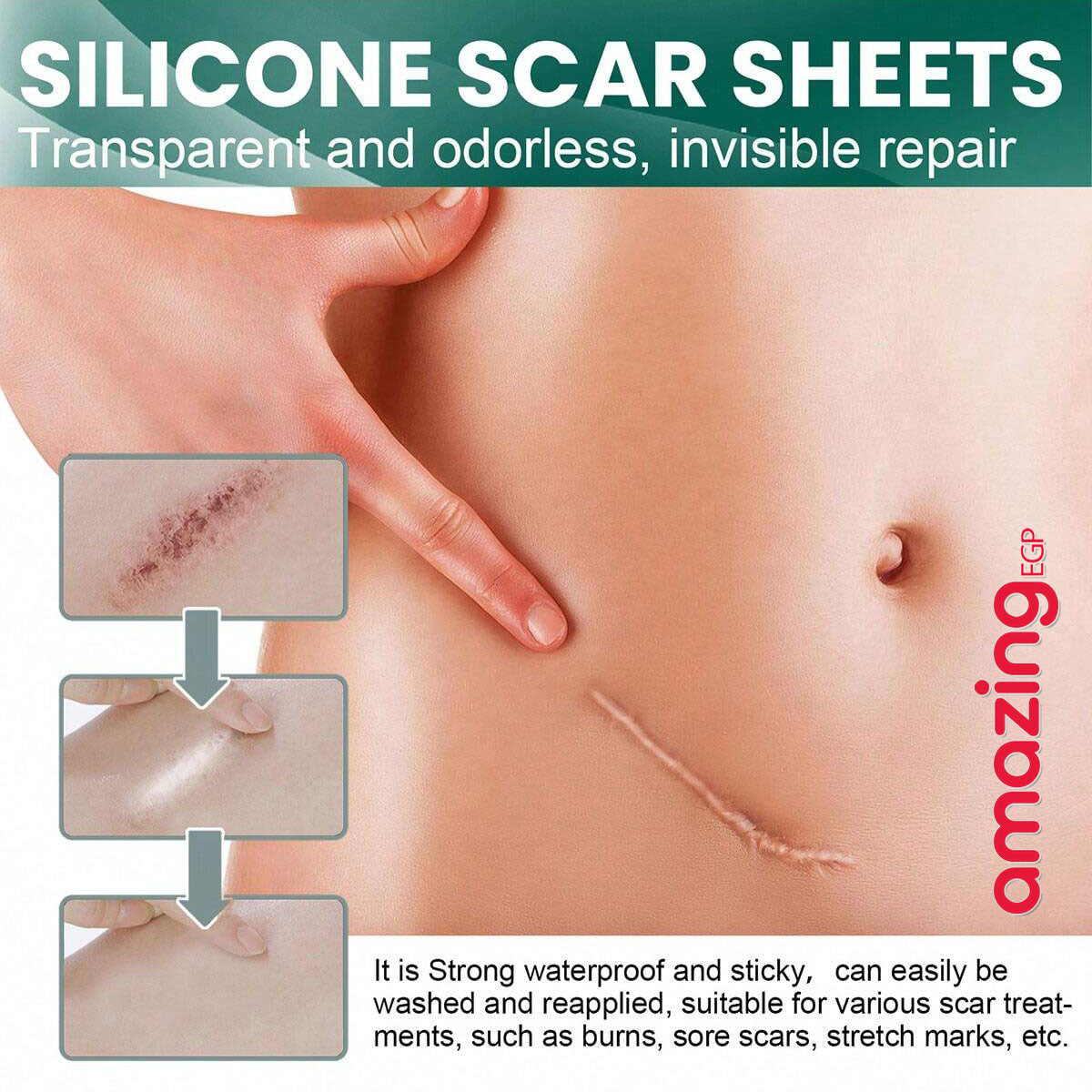 شرائح سيليكون طبية للندبات – شريط سيليكون لإزالة آثار الجروح والعمليات (4 سم × 150 سم)