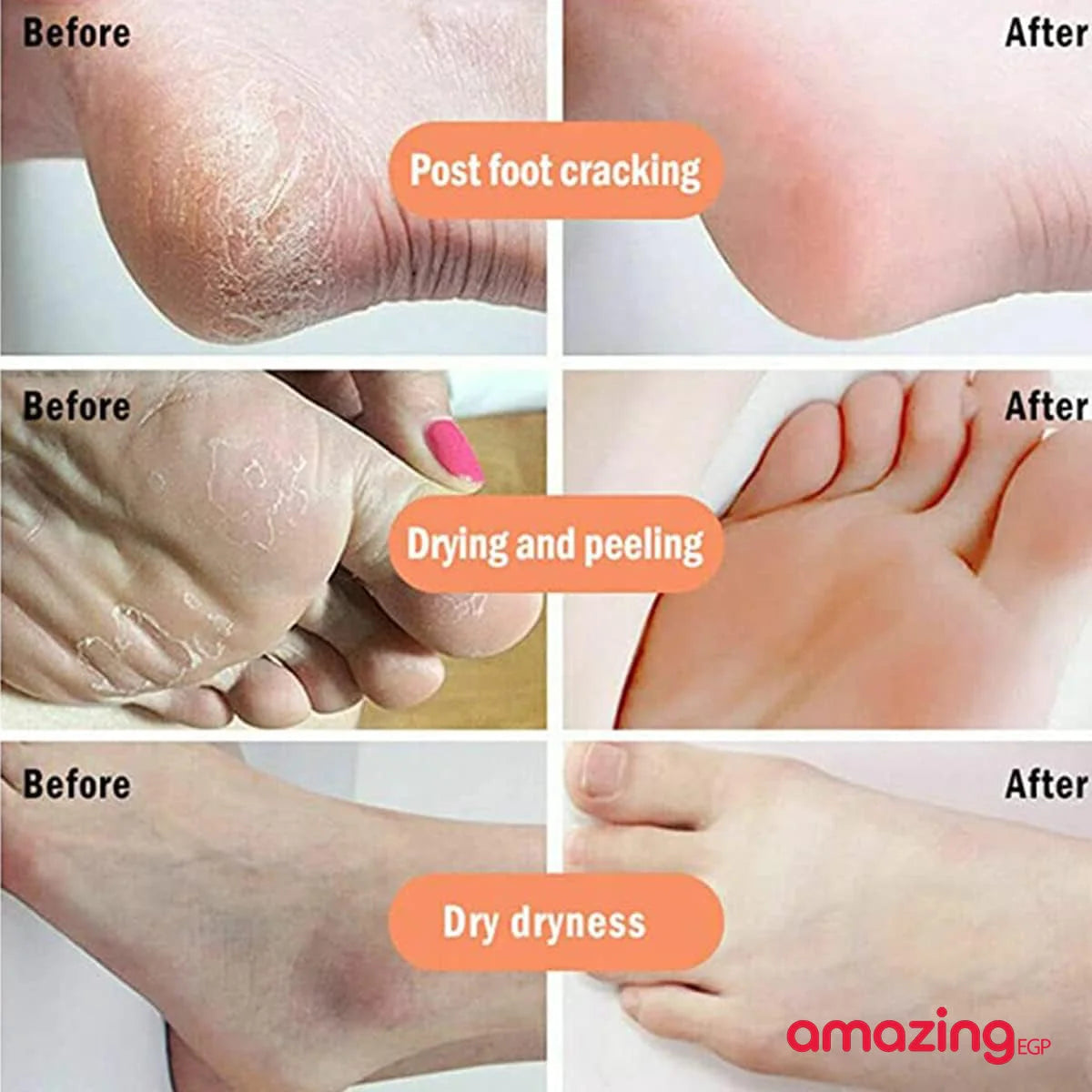 كريم اليد والقدم للبشرة المتشققة بعسل مانوكا مرطب ومرطب للأقدام الجافة كريم إصلاح الجلد المتشقق كريم إصلاح كعب القدم المتشقق | اسود الابط الباط البقع الداكنة البيكيني المناطق الحساسة تفتيح الباط تفتيح البيكيني داكن الجسم مكياج | amazingEGP
