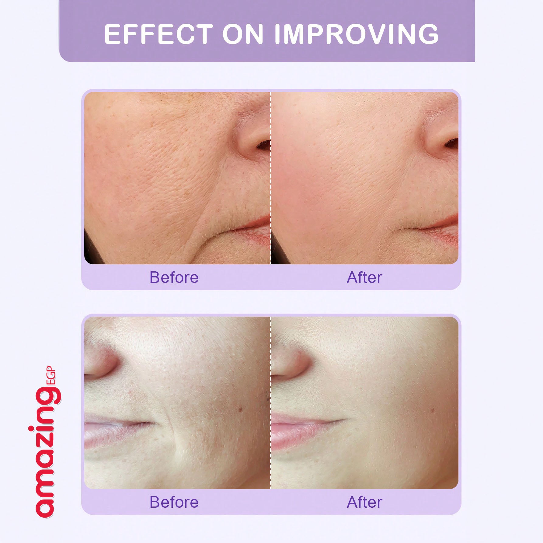 رقع علاج تجاعيد الجبهة شريط وجه للتجاعيد - رقعة الجبين - رقع مضادة للتجاعيد - رقع تجاعيد للوجه والجبهة علاج تجاعيد الوجه