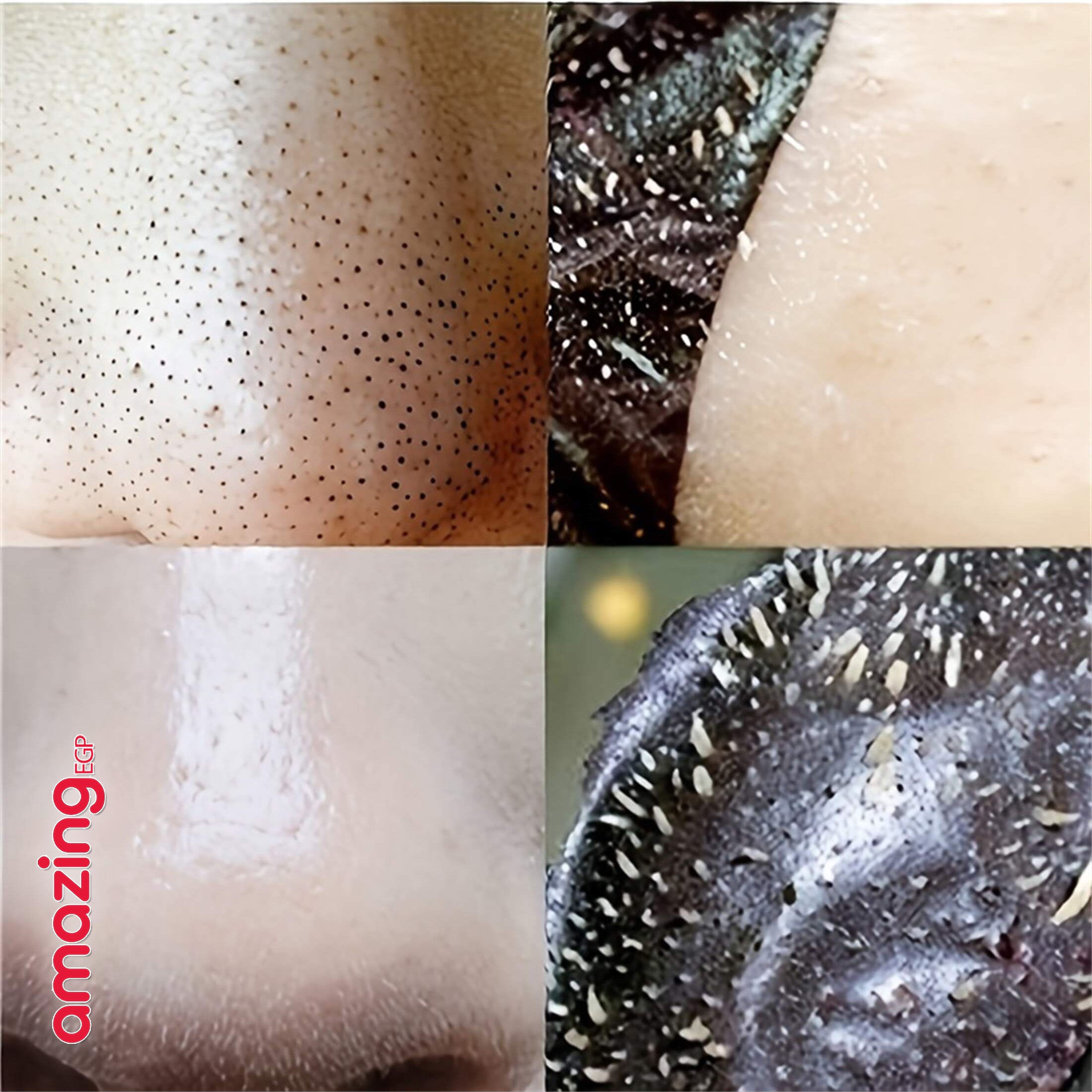 شرائح تنظيف الأنف لإزالة الرؤوس السوداء  للنساء والرجال - 5 قطع