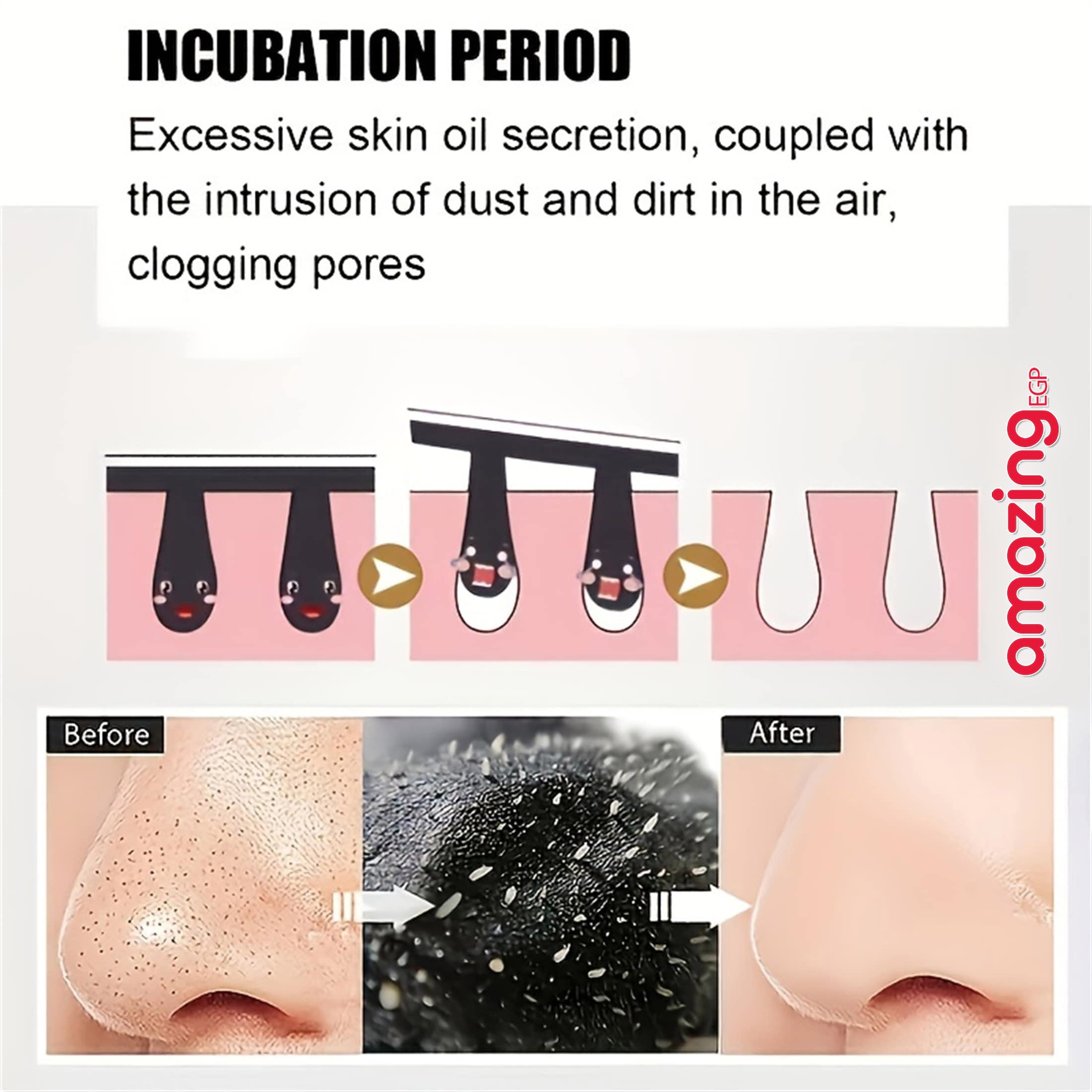 شرائح تنظيف الأنف لإزالة الرؤوس السوداء  للنساء والرجال - 5 قطع