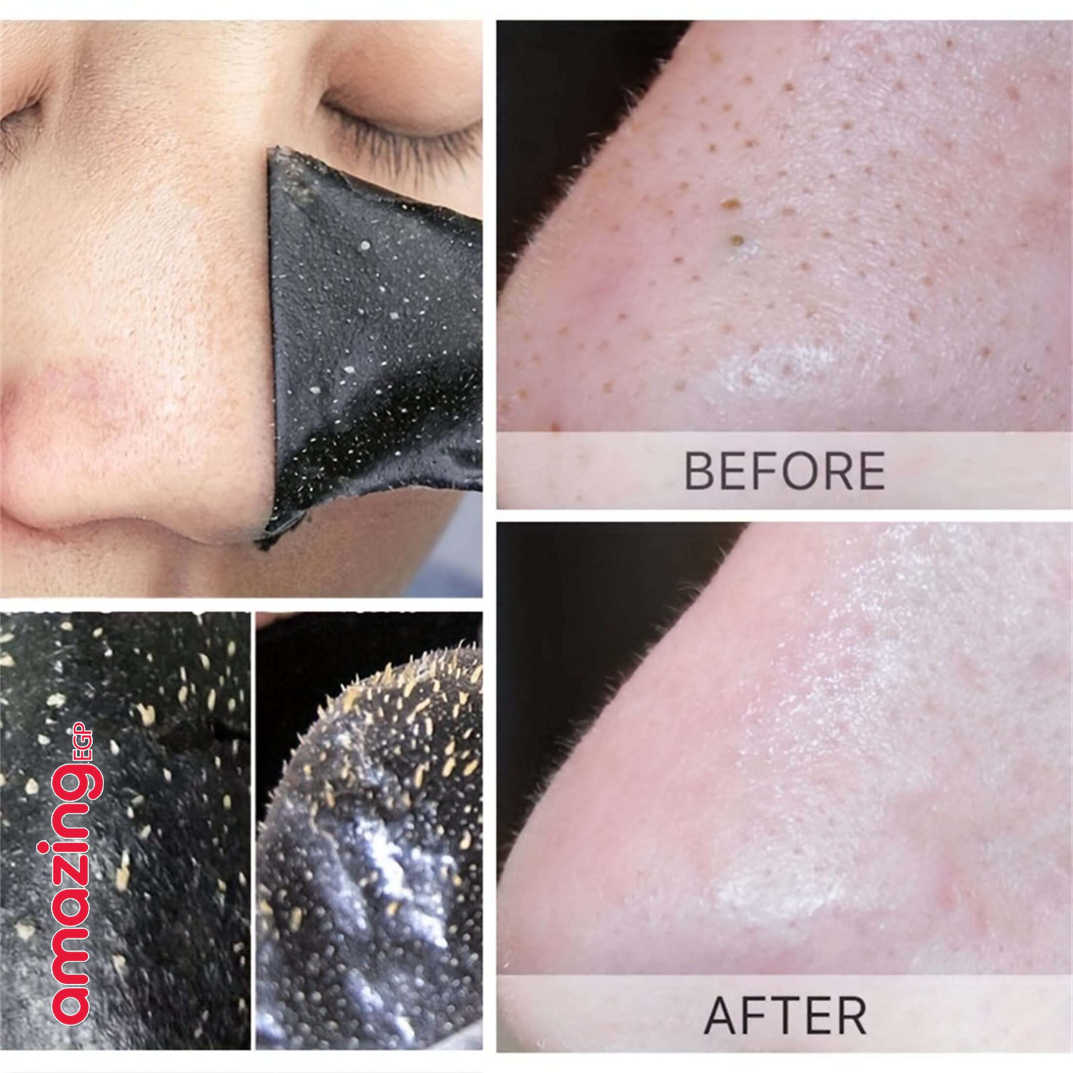 شرائح تنظيف الأنف لإزالة الرؤوس السوداء  للنساء والرجال - 5 قطع